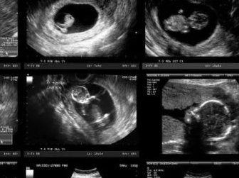 皇家生殖遗传医院的胚胎冷冻技术与成功率分析